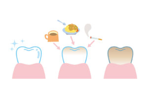 歯の着色汚れ