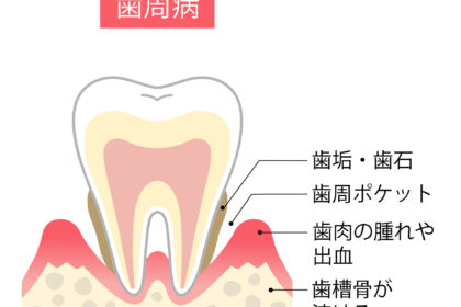 歯周病とは