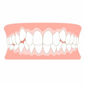 八重歯がある歯並び