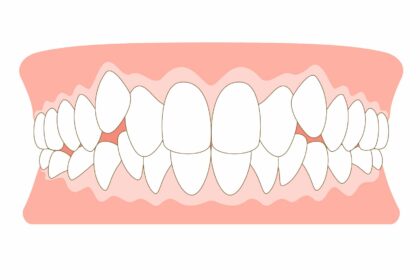 八重歯がある歯並び
